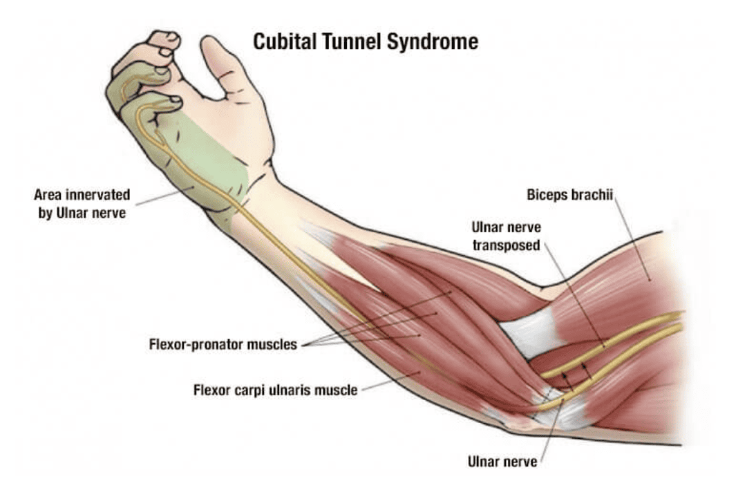 Cubital Tunnel Syndrome. The ulnar nerve originates from the…